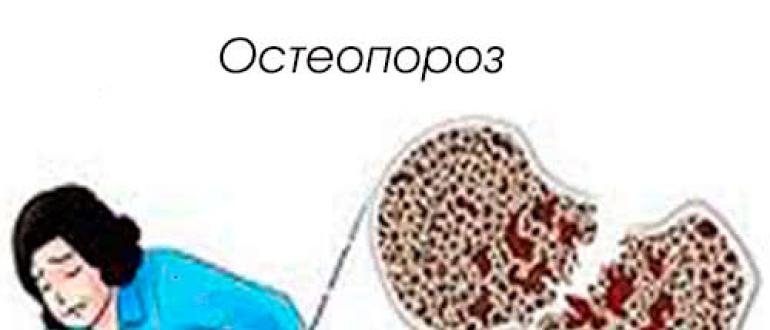 Остеопороз - причины, симптомы и признаки, диагностика и лечение