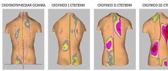 Лечение сколиоза грудного отдела позвоночника